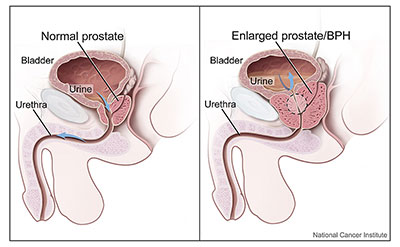 prostatitis a belek miatt az első alkalom a prosztatitis